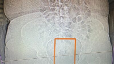 Erzincan’da polis ekipleri yaptıkları çalışma kapsamında şüpheli bir kişinin midesinde